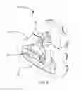 Fig. 03 - Facial mask with internal intermediate maxilla support for use with ventilation and positive air pressure systems