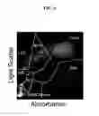 Fig. 06 - MARKER DETECTION FOR CHARACTERIZING THE RISK OF CARDIOVASCULAR DISEASE OR COMPLICATIONS THEREOF