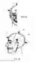 Fig. 02 - Detection of Concussion Using Cranial Accelerometry