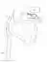Fig. 01 - MULTI-LUMEN CATHETER FOR CARDIAC DEVICE DEPLOYMENT