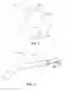 Fig. 02 - MULTI-LUMEN CATHETER FOR CARDIAC DEVICE DEPLOYMENT