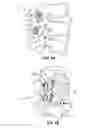 Fig. 03 - Translaminar interspinous stabilization system