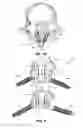 Fig. 04 - Translaminar interspinous stabilization system