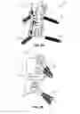 Fig. 05 - Translaminar interspinous stabilization system