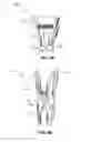 Fig. 08 - Translaminar interspinous stabilization system