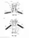 Fig. 10 - Translaminar interspinous stabilization system