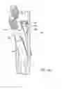 Fig. 07 - Lockable intramedullary fixation device
