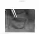 Fig. 07 - Emulsions or microemulsions for use in endoscopic mucosal resectioning and/or endoscopic submucosal dissection