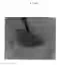 Fig. 08 - Emulsions or microemulsions for use in endoscopic mucosal resectioning and/or endoscopic submucosal dissection