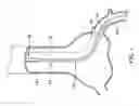 Fig. 02 - Trap balloon catheter with trap balloon retainer