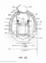 Fig. 04 - Anatomically customized ear canal hearing apparatus