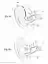 Fig. 03 - Hearing aid device and method for feedback reduction