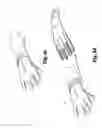Fig. 07 - Device adapted to facilitate insertion of a hand into a glove