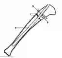 Fig. 01 - GUIDE DEVICE FOR INSERTION OF BLOCKING SCREWS USED TO ALIGN INSERTION OF INTRAMEDULLARY NAIL