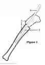 Fig. 02 - GUIDE DEVICE FOR INSERTION OF BLOCKING SCREWS USED TO ALIGN INSERTION OF INTRAMEDULLARY NAIL