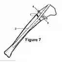 Fig. 08 - GUIDE DEVICE FOR INSERTION OF BLOCKING SCREWS USED TO ALIGN INSERTION OF INTRAMEDULLARY NAIL