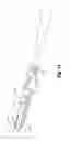 Fig. 15 - Electrosurgical forceps