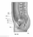 Fig. 04 - System and method for electrical stimulation of anorectal structures to treat urinary dysfunction