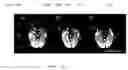 Fig. 01 - Image domain segmented echo planar magnetic resonance imaging using a 2D excitation radiofrequency pulse