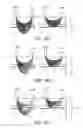 Fig. 23 - System and Method for Mitigating the Effects of Tissue Blood Volume Changes to Aid in Diagnosing Infiltration or Extravasation in Animalia Tissue