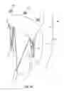 Fig. 02 - Methods of delivering and deploying a heart valve apparatus at a mitral valve