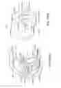 Fig. 131 - Patient-adapted and improved articular implants, designs and related guide tools