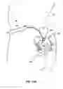 Fig. 12 - Cannula configured to deliver test stimulation
