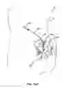 Fig. 15 - Cannula configured to deliver test stimulation