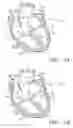 Fig. 02 - Prosthetic tissue valves