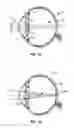 Fig. 02 - Multi-ring lens, systems and methods for extended depth of focus