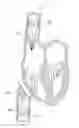 Fig. 01 - Apparatus for treating a heart valve
