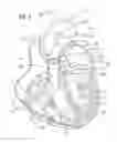 Fig. 02 - Apparatus for treating a heart valve