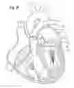Fig. 22 - Apparatus for treating a heart valve