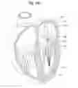 Fig. 35 - Apparatus for treating a heart valve