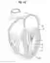 Fig. 41 - Apparatus for treating a heart valve