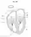 Fig. 43 - Apparatus for treating a heart valve