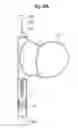 Fig. 71 - Apparatus for treating a heart valve