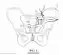 Fig. 02 - Methods of fusing a sacroiliac joint