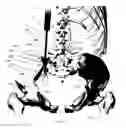 Fig. 32 - Methods of fusing a sacroiliac joint