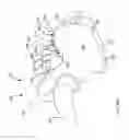 Fig. 45 - Methods of fusing a sacroiliac joint