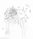 Fig. 46 - Methods of fusing a sacroiliac joint