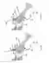 Fig. 50 - Methods of fusing a sacroiliac joint
