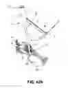 Fig. 55 - Methods of fusing a sacroiliac joint