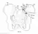 Fig. 68 - Methods of fusing a sacroiliac joint