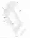Fig. 79 - Methods of fusing a sacroiliac joint