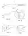 Fig. 02 - Methods and instruments for forming a posterior knee portal and for inserting a cannula