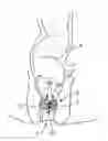 Fig. 01 - Fecal incontinence treatment device and method