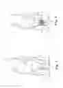Fig. 02 - Fecal incontinence treatment device and method