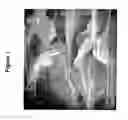 Fig. 02 - METHOD FOR IMPROVEMENT OF DIFFERENTIATION OF MESENCHYMAL STEM CELLS USING A DOUBLE-STRUCTURED TISSUE IMPLANT