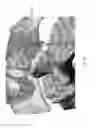Fig. 12 - Bone screw and implant delivery device